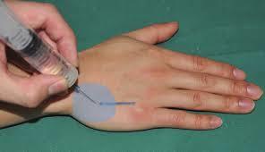 Lire la suite à propos de l’article Mise en place de la WALANT au CHV pour la chirurgie de la main