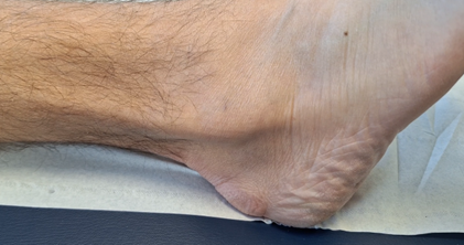 Lire la suite à propos de l’article Focus sur : L’instabilité des tendons fibulaires